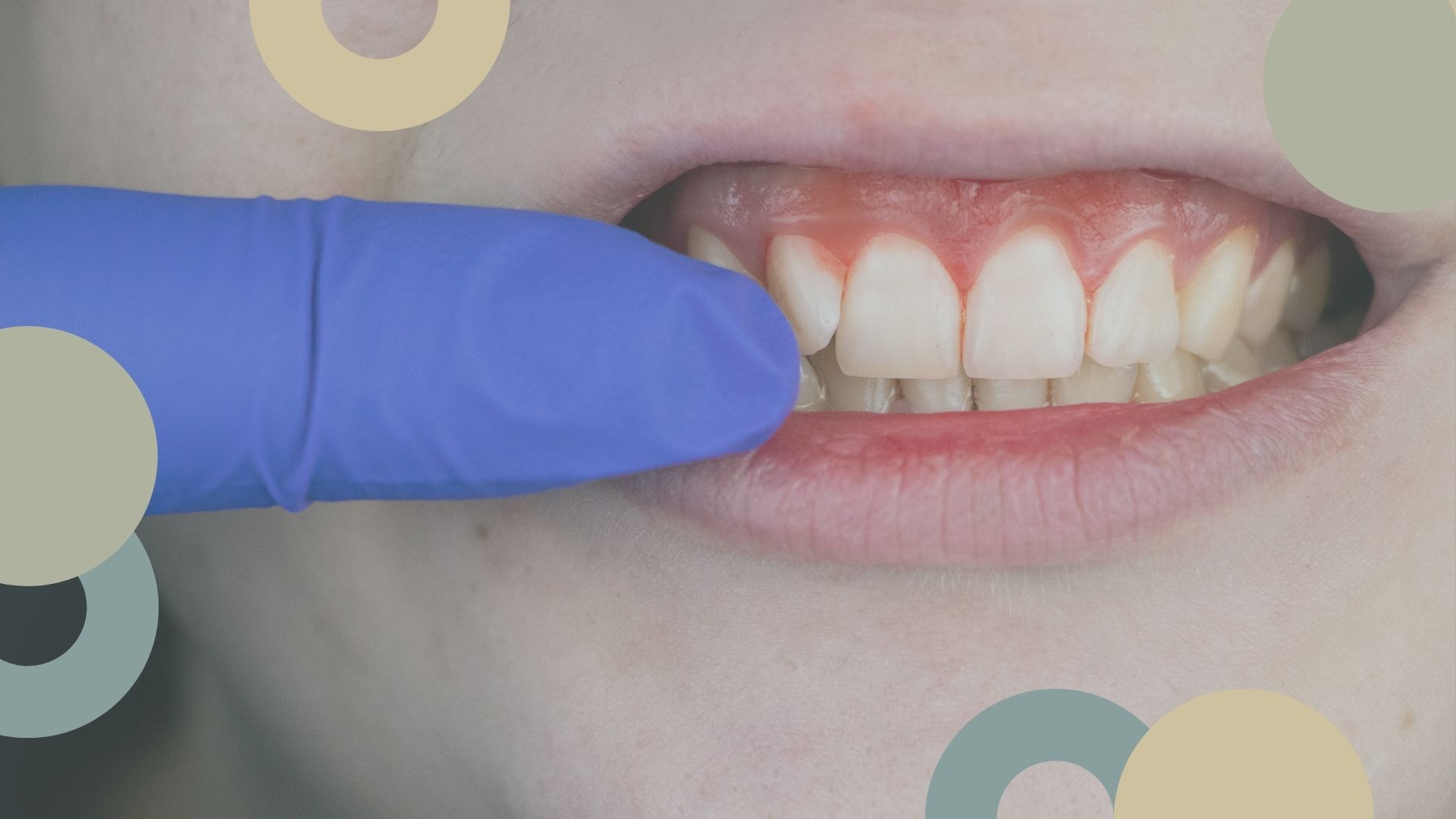 sangrado de encias | ClÃ­nica Dental SÃ¡nchez SolÃ­s