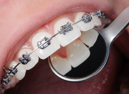 Ventajas de la Ortodoncia | Clínica Dental Sevilla