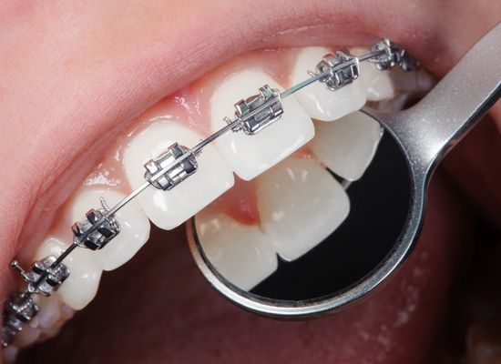 Ventajas de la Ortodoncia | ClÃ­nica Dental Sevilla