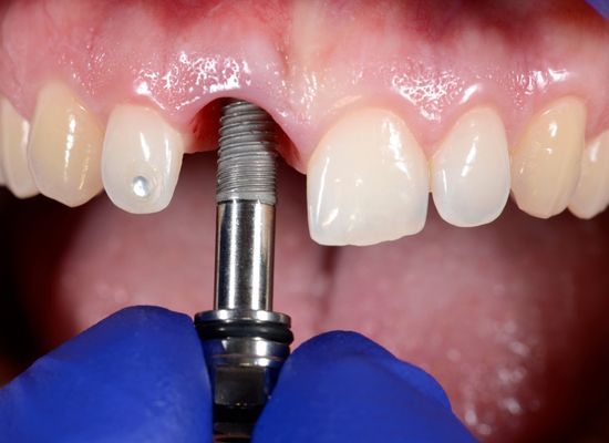 Uso de implantes dentales en Sevilla | Sánchez Solís