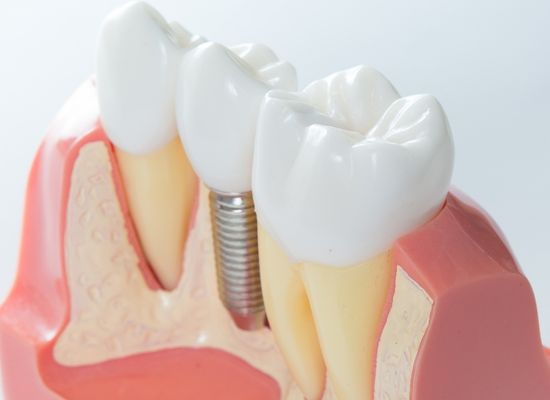 Tipos de implantes dentales | Sevilla Este