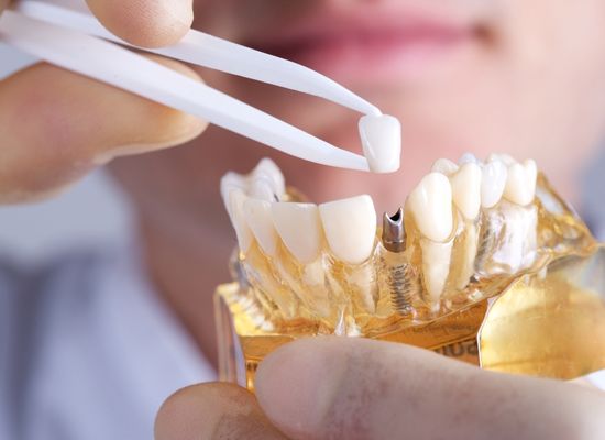 Partes de Implantología | Sánchez Solís Dentista | Sevilla