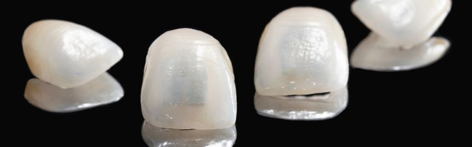 carillas dentales sevilla | SÃ¡nchez SolÃ­s ClÃ­nica