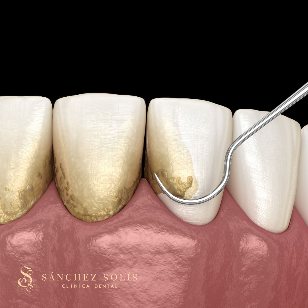 Tratamiento periodontitis | Clínica Dental Sevilla