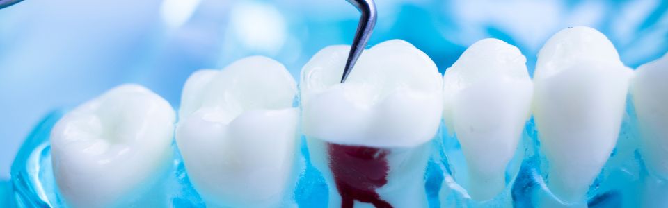 Endodoncia Sevilla Este | ClÃnica Dental Sánchez SolÃs