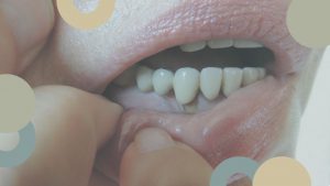 Periodontitis | ClÃ­nica Dental SÃ¡nchez SolÃ­s | Sevilla