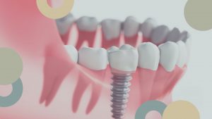ImplantologÃ­a Dental | ClÃ­nica Dental SÃ¡nchez SolÃ­s