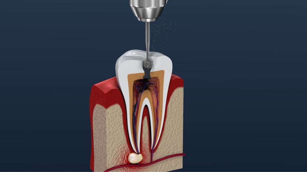 En quÃ© consiste la endodoncia| SÃ¡nchez Solis Dentista| Sevilla