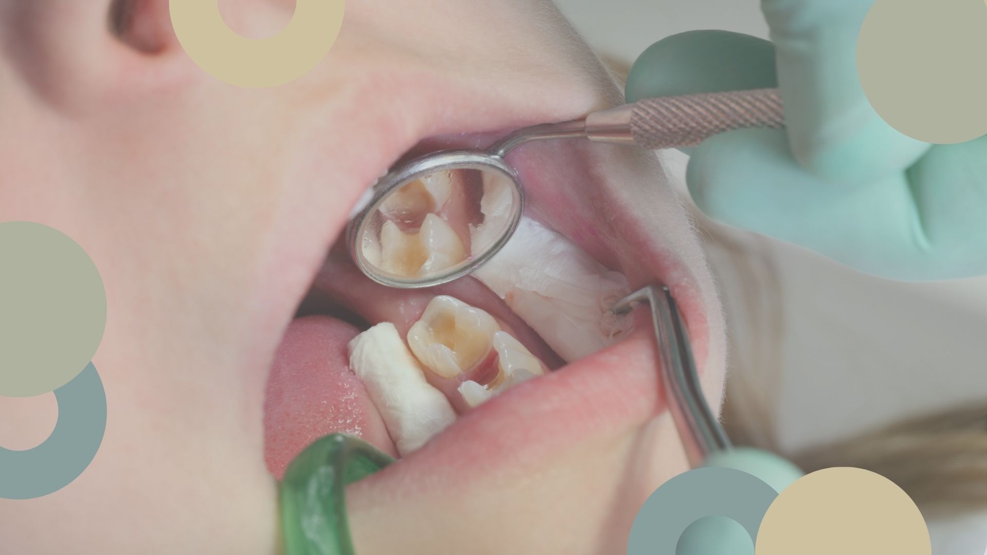Caries dental | Sánchez Solís dentista
