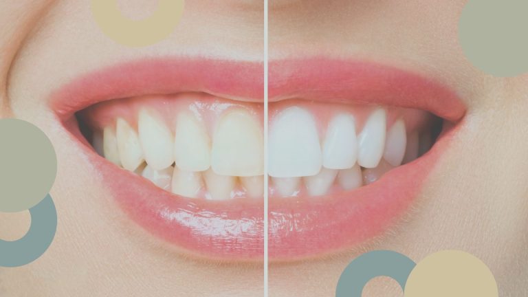 Blanqueamiento dental | Sánchez Solís Dentista