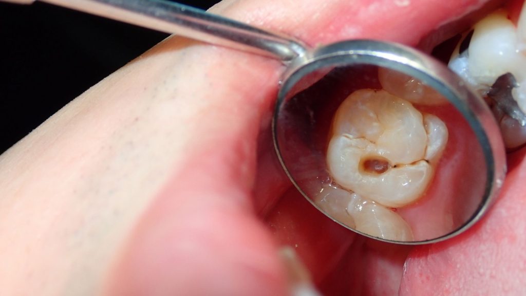 ObturaciÃ³n dental | ClÃ­nica Dental Dr SÃ¡nchez SolÃ­s