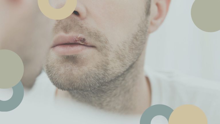 Herpes Labial | SÃ¡nchez SolÃ­s Dentista