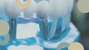 Novedades en implantología dental | Clínica Sevilla
