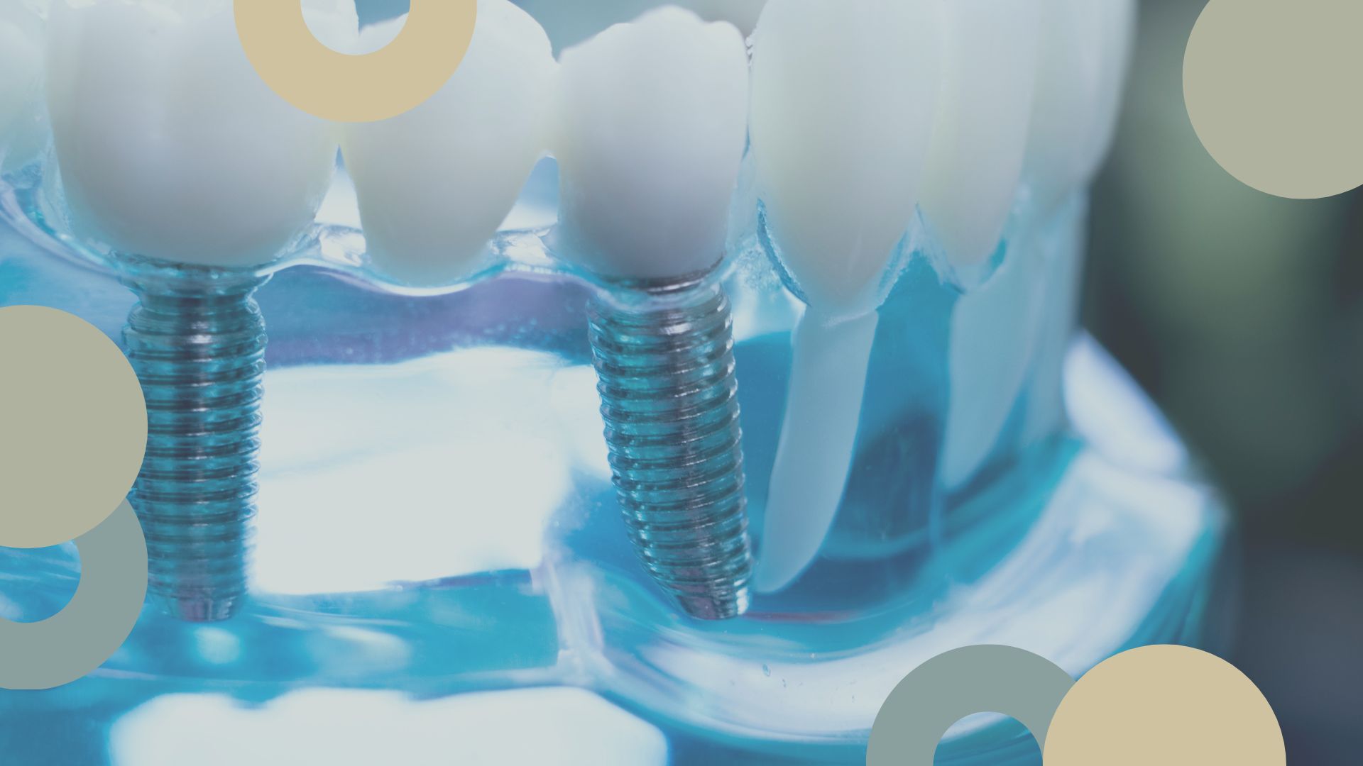 Novedades en implantología dental | Clínica Sevilla
