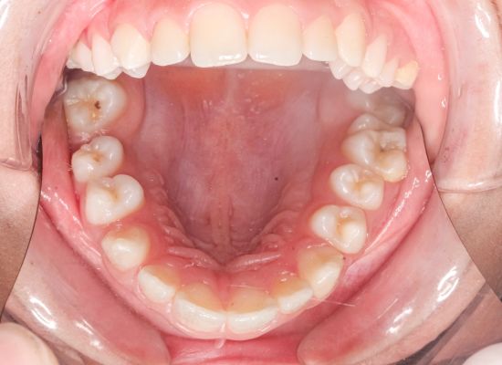 Diagnóstico Endodoncia | Dentista Sevilla