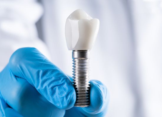 Tipos de implantes sevilla | Clínica Dental