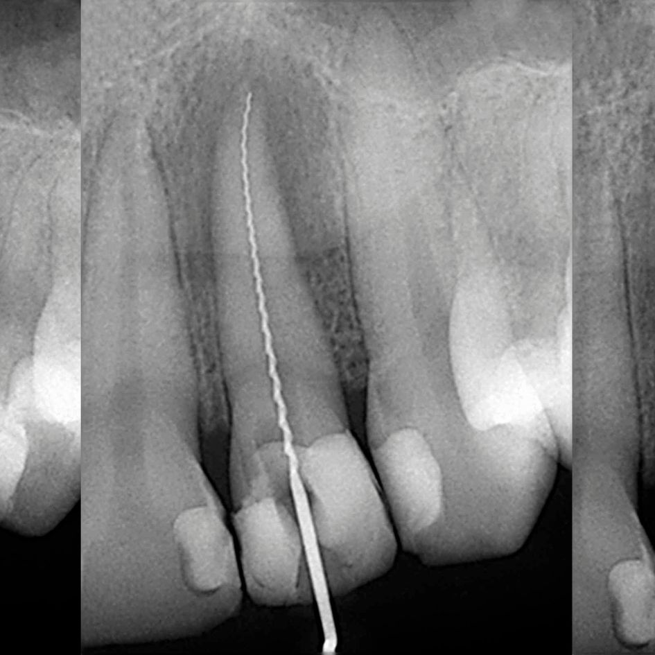 diagnóstico endodoncia sevilla este