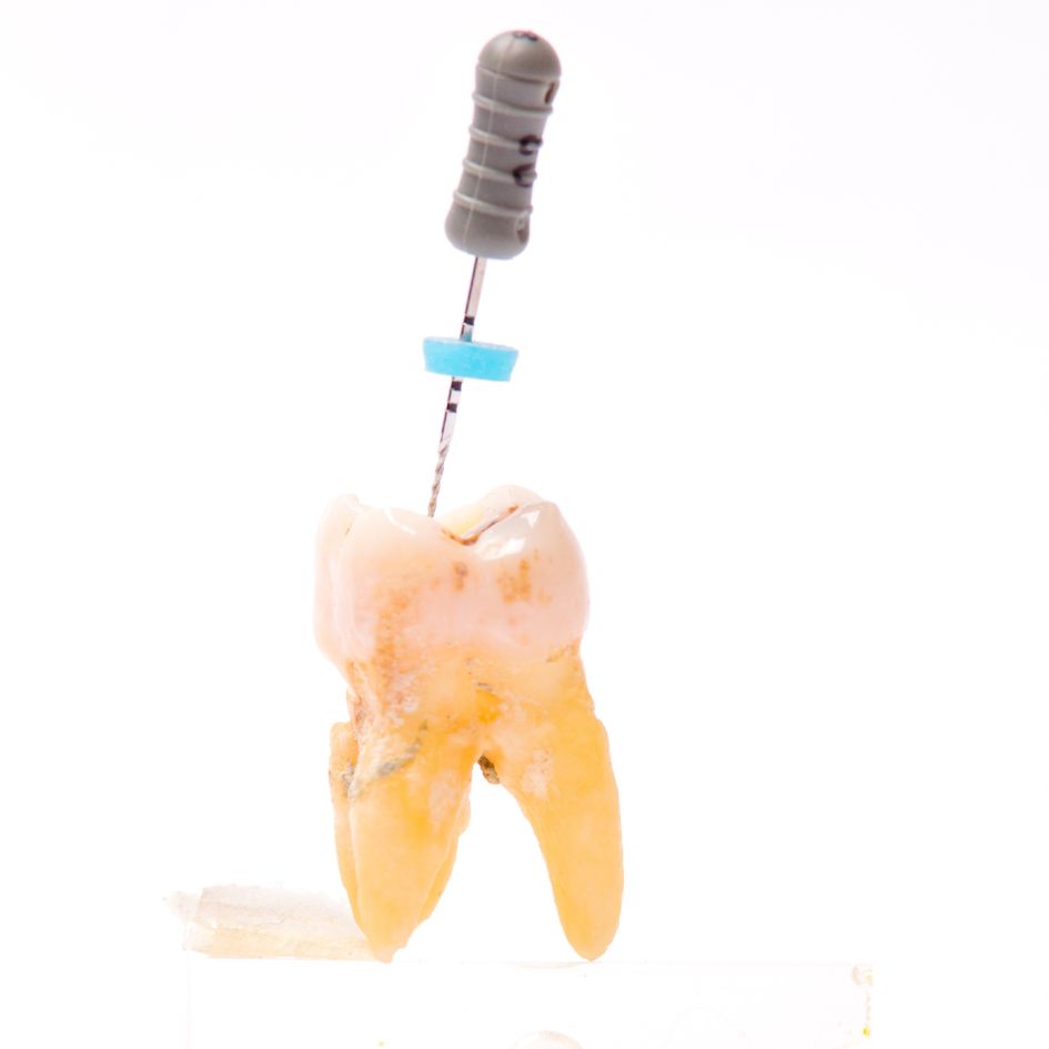 tratamiento de endodoncia | Sánchez Solís Dentista