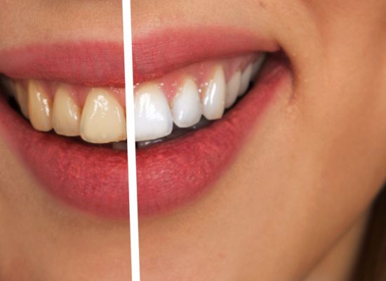 Estética Dental Blanqueamiento | Sevilla Este