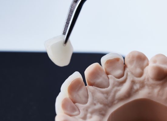 Estética Dental Carillas | Sevilla Este