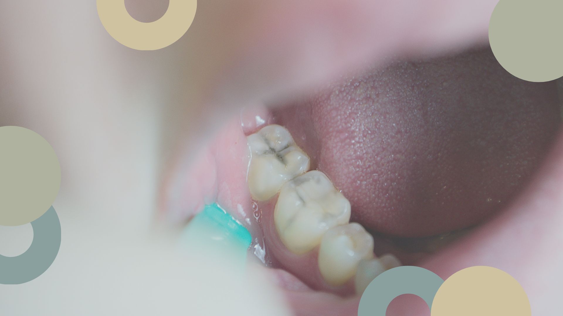 Caries infantil | Clínica Dental | Sevilla Este
